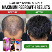 Hair Regrowth Bundle (Onion+Rosemary+Amla Retha Sikakai) oil