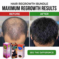 Hair Regrowth Bundle (Onion+Rosemary+Amla Retha Sikakai) oil